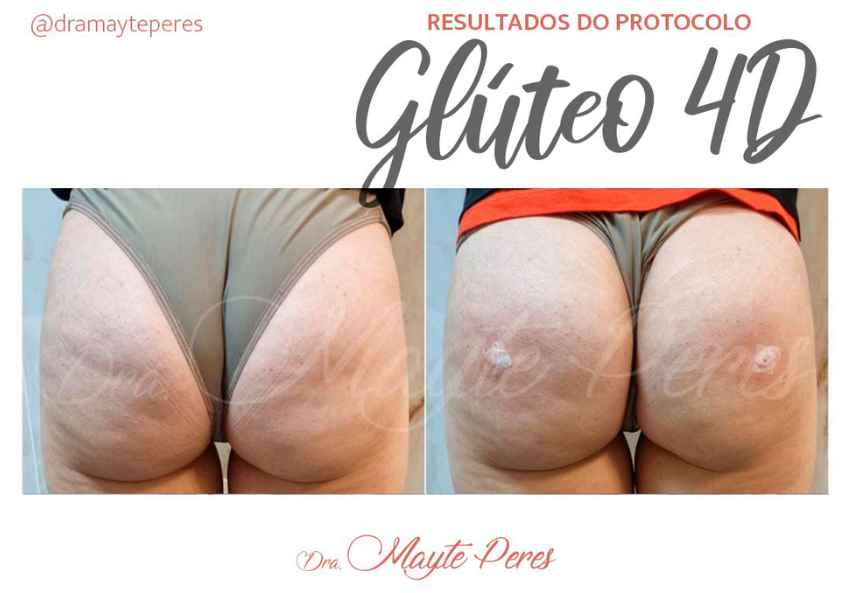 Centro Estético Dra. Mayte Peres - Resultado Glúteo 4D
