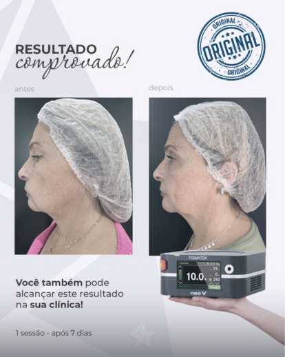 Centro Estético Dra. Mayte Peres - Resultado Endolaser